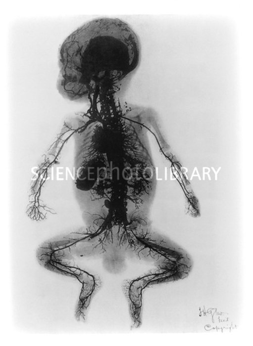 ^BX-ray arteriogram of a child (1899).^b Early X-ray showing in fine detail the arteries in a child's body. The X-ray was made in 1899 at St. Thomas' Hospital in London, and published in the ^IArchives^i ^Iof the Roentgen Ray.^i It was titled: "An injected infant". The cadaver of a young boy was injected, at the femoral artery of the leg, with four pounds of mercury.