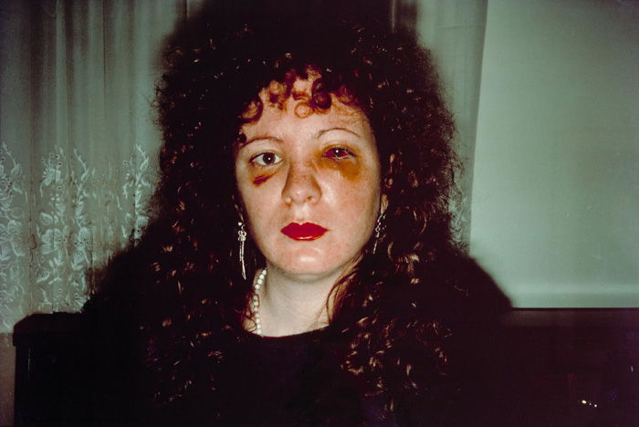 Nan one month after being battered - Nan Goldin (1984) - controversial photos