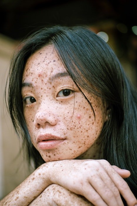 Portrait of a freckled girl